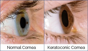keratoconus corneal transplant
