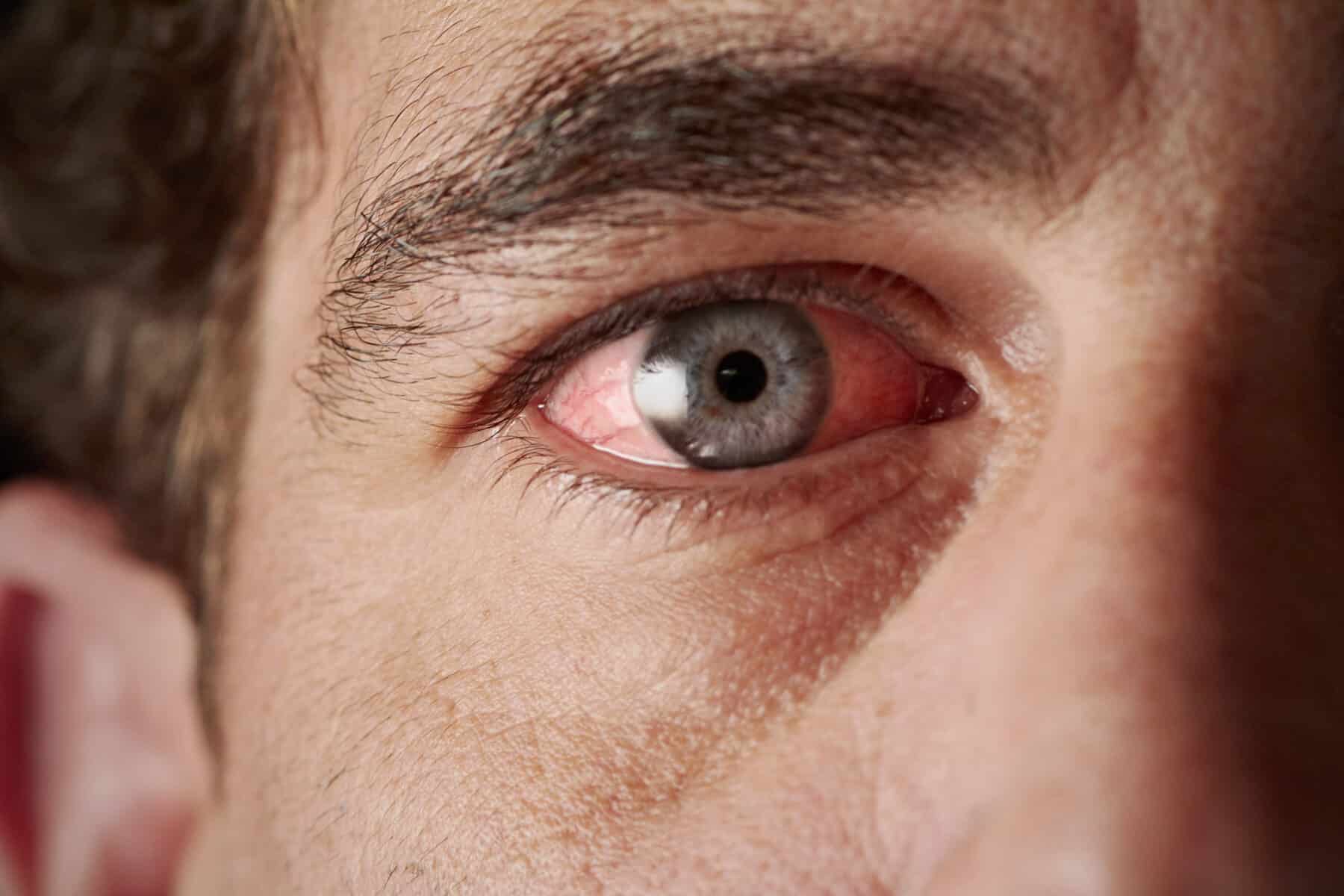 Sharp Pain in Eye