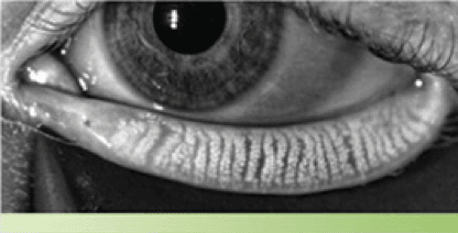 Dry Eye Treatment at Eye Clinics in Michigan