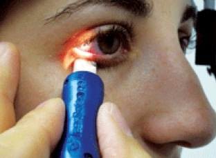 Dry Eye Syndrome Symptoms and Treatment