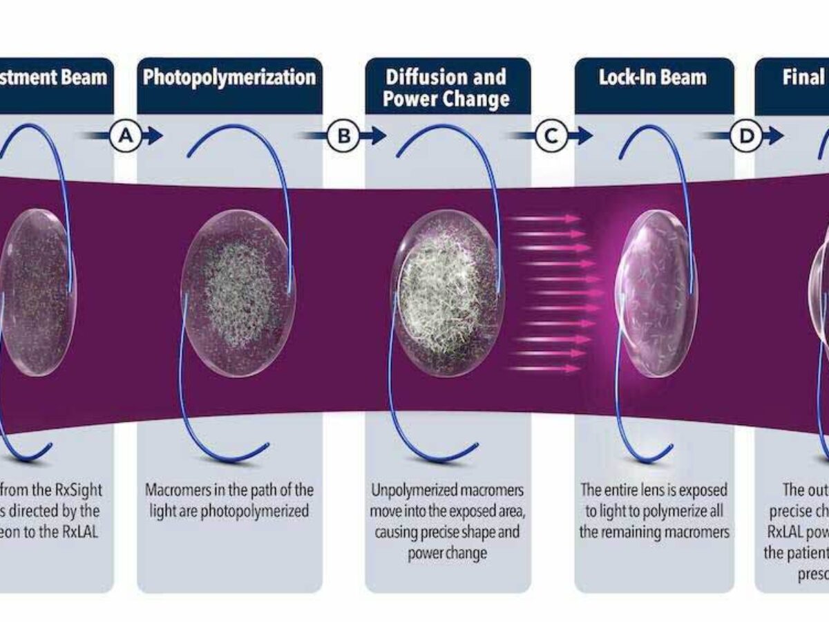 The Light Adjustable Lens (LAL)