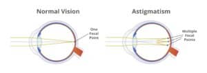 Normal Vision Vs Astigmatism diagram