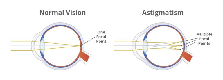 TORIC Lens Implant For Cataract Surgery