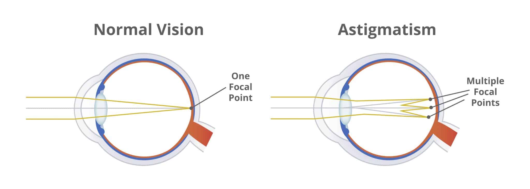 Lente intraocular online vivity