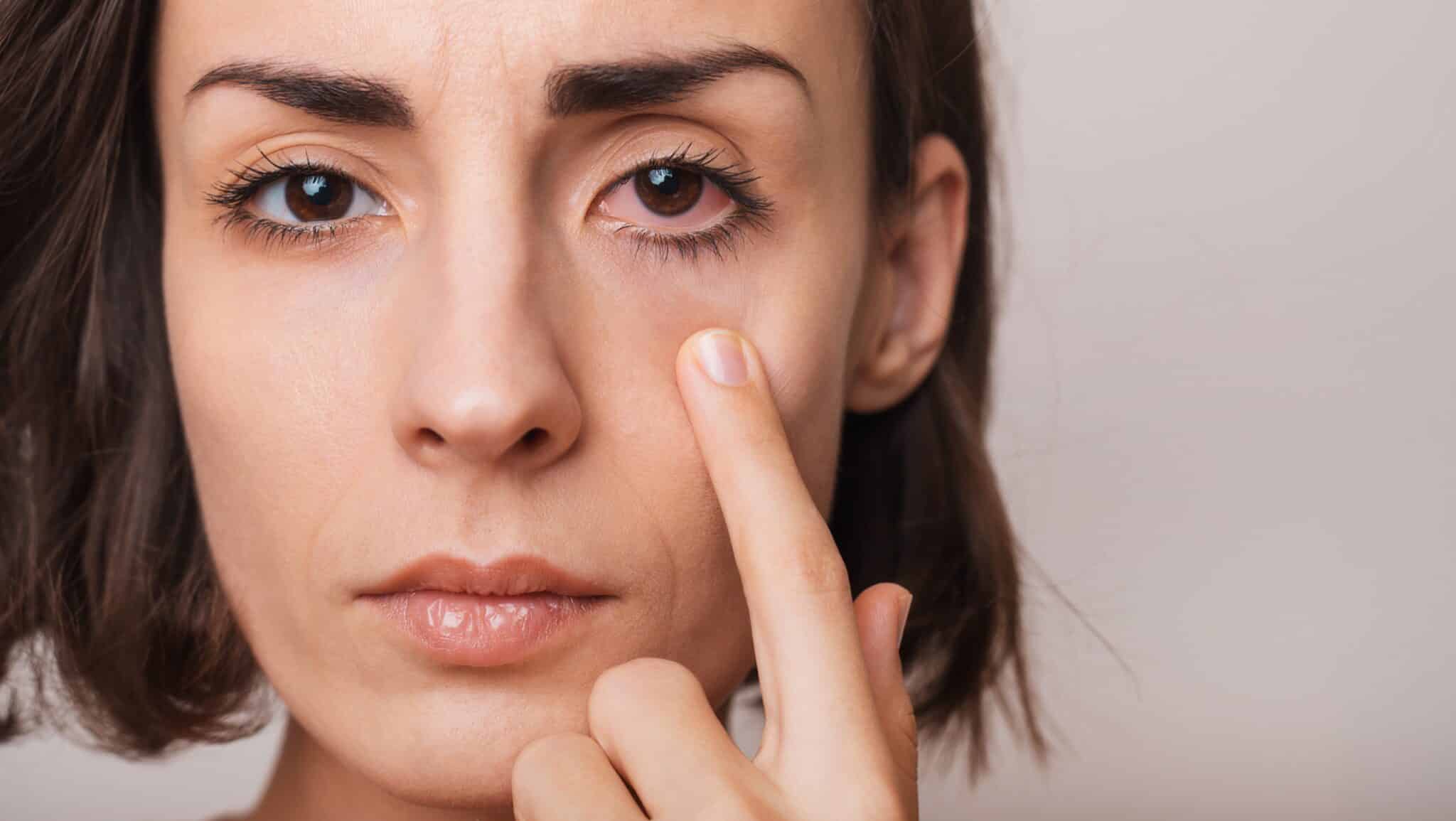 Home Remedies for Bloodshot Eyes